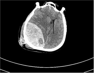 Non-invasive Evaluation of Brain Death Caused by Traumatic Brain Injury by Ultrasound Imaging